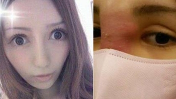 Wajah Nyaris Membusuk karena Operasi Plastik