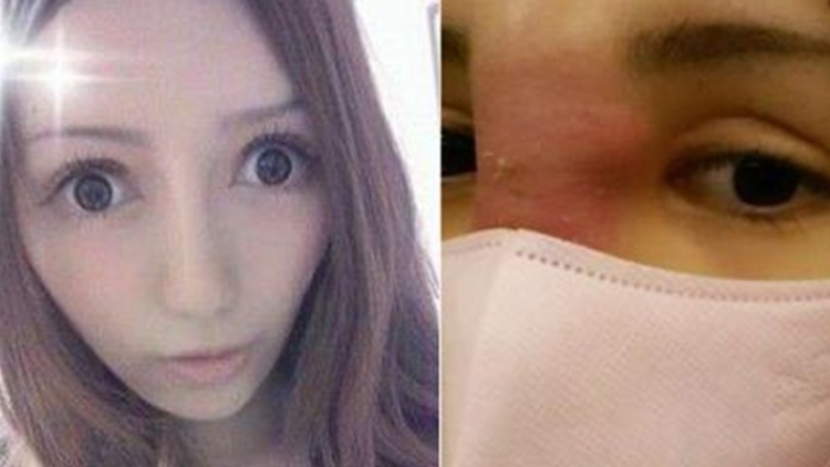 Wajah Nyaris Membusuk karena Operasi Plastik Wajah Nyaris Membusuk karena Operasi Plastik